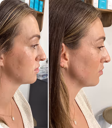 Side-by-side profile images of a woman showing facial skin before and after treatment.