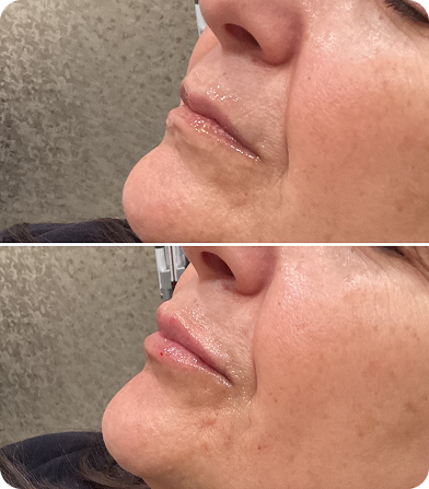 Close-up before and after images showing fuller lips and reduced wrinkles on a woman's lower face.