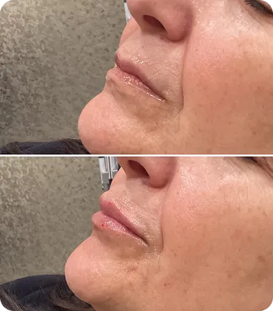 Close-up before and after images showing fuller lips and reduced wrinkles on a woman's lower face.