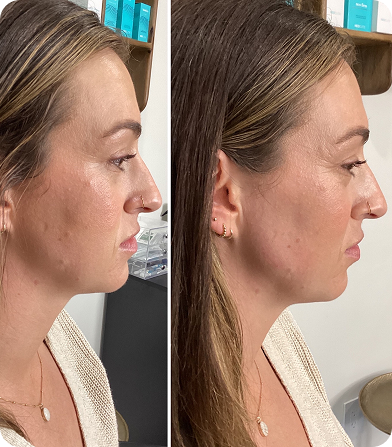 Side-by-side profile photos showing a woman before and after a cosmetic treatment on her nose and jawline.