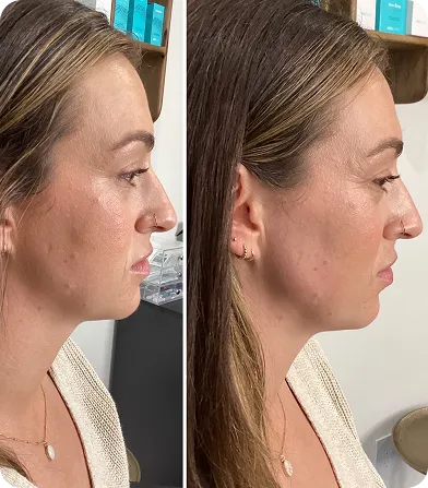 Side-by-side profile photos showing a woman before and after a cosmetic treatment on her nose and jawline.