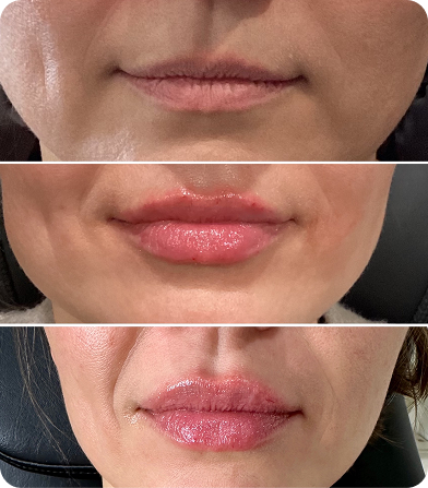 Three close-up images of a person's lips showing before and after lip enhancement with gloss applied.