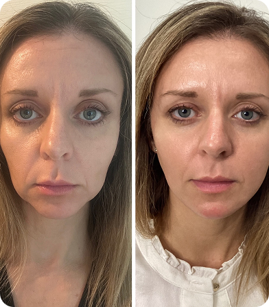 Side-by-side close-up of a woman's face showing before and after skin treatment results.