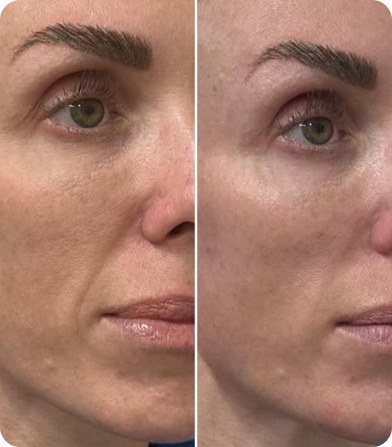 Side-by-side photos showing facial skin before and after treatment with improved texture and reduced wrinkles.