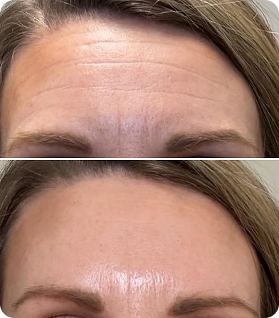 Before and after comparison showing a forehead with wrinkles and one with smooth skin after treatment.