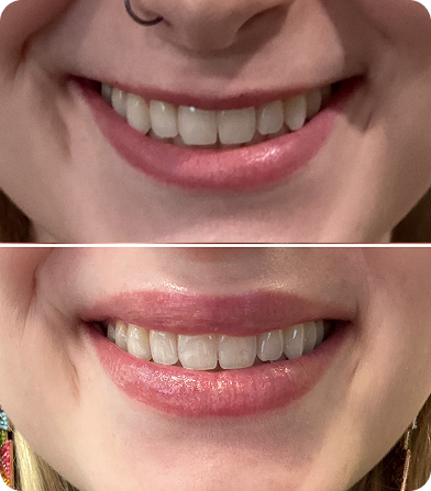 Close-up comparison of two smiles showing different teeth color and lip tone.
