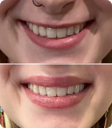 Close-up comparison of two smiles showing different teeth color and lip tone.