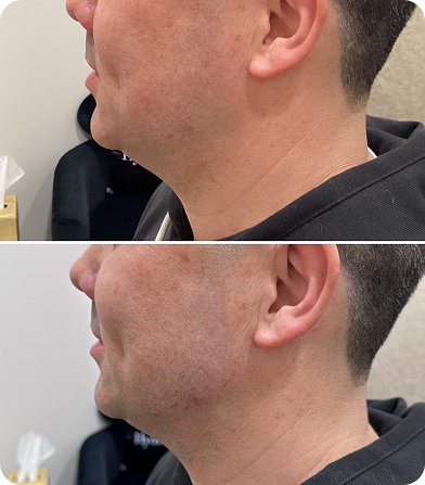Side-by-side profile shots showing a man's jawline before and after skin treatment or irritation.