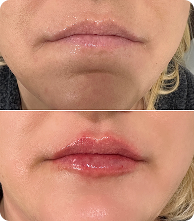 Close-up of lips before and after a cosmetic lip enhancement procedure showing fuller, glossier lips.