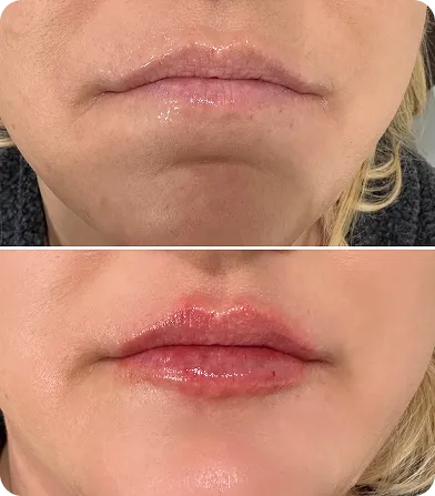 Close-up of lips before and after a cosmetic lip enhancement procedure showing fuller, glossier lips.