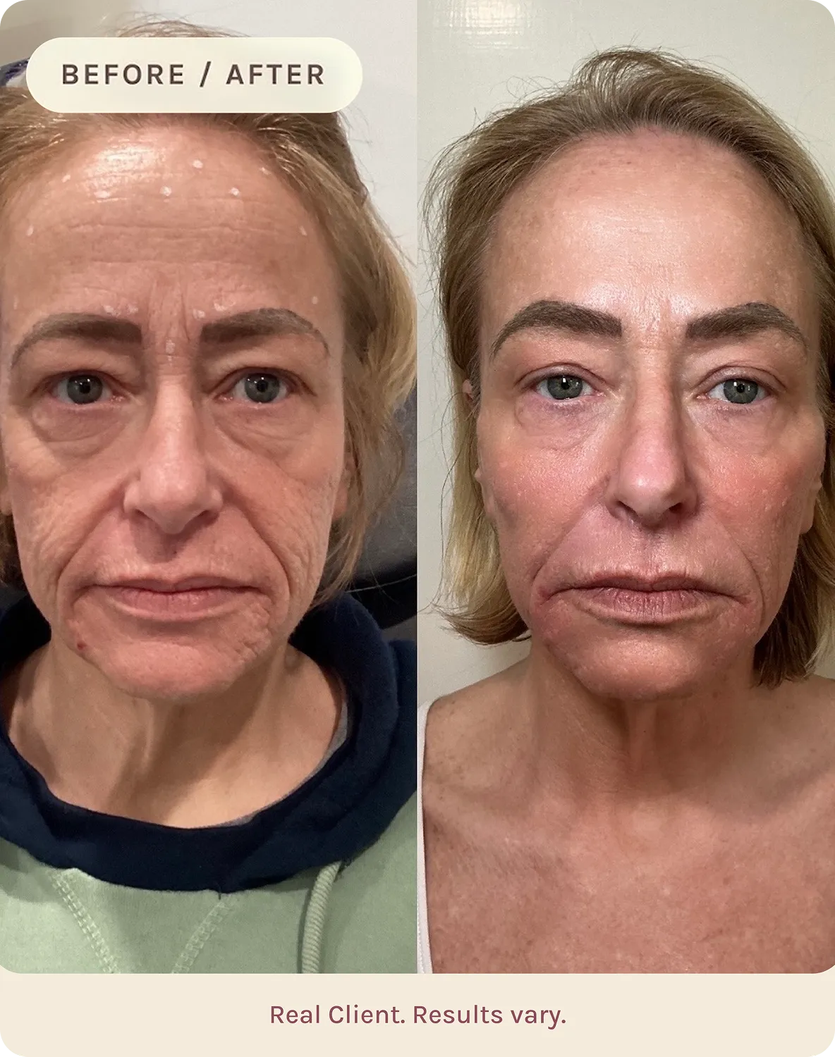 Side-by-side before and after photos of a middle-aged woman showing reduced wrinkles and improved skin texture.