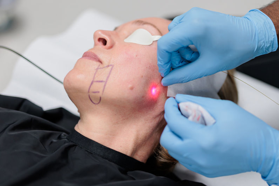 Close-up of a woman's face receiving endolift treatment with eye protection and blue-gloved hands.