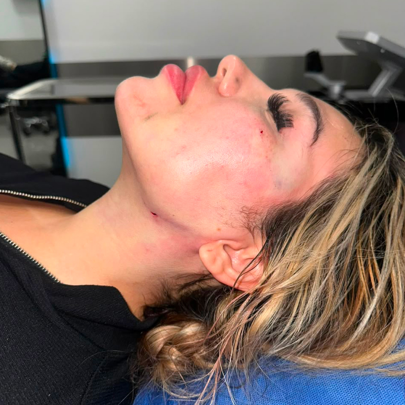 facelift before and after tijuana