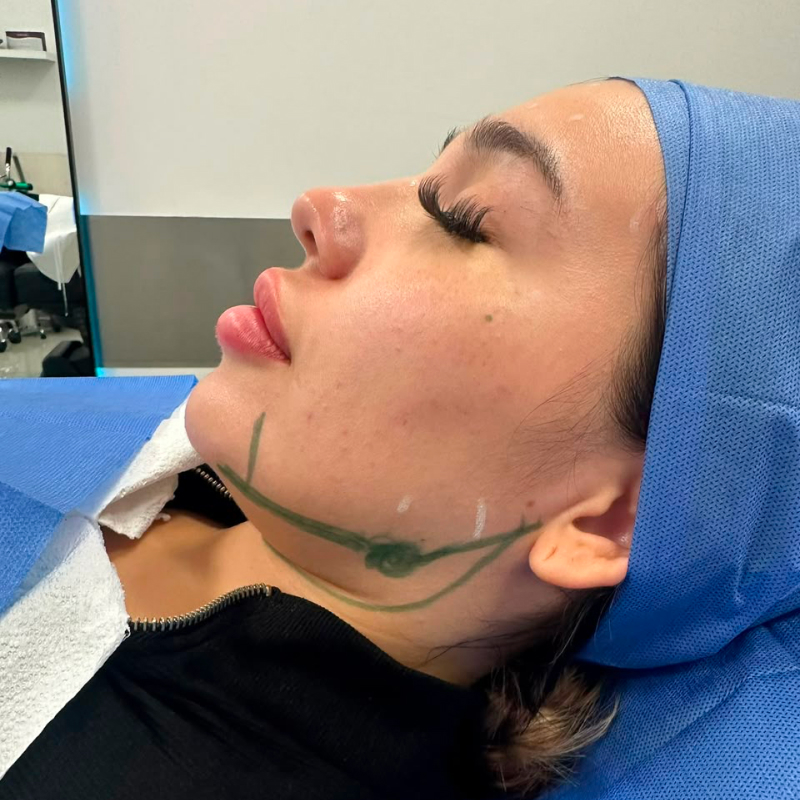 facelift before and after tijuana