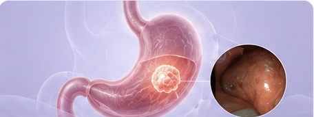 “Gastric