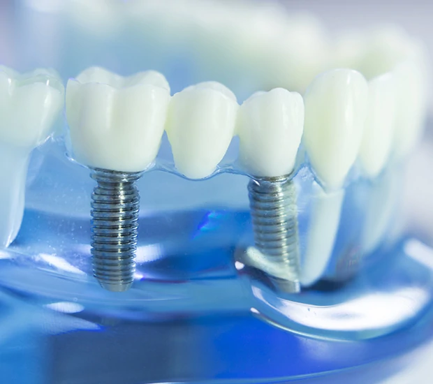 Dental implants