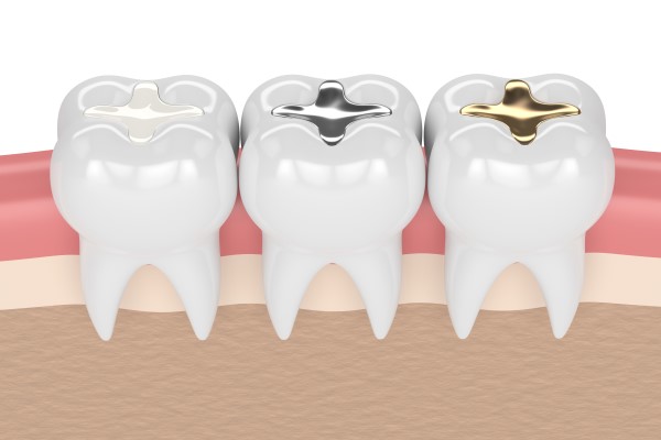 How Does a Dental Filling Work?