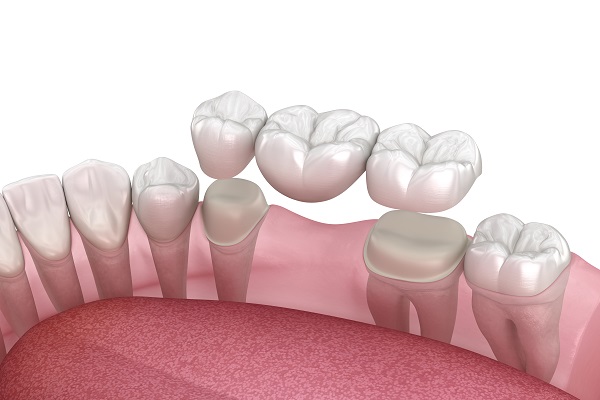 When is a Dental Bridge Recommended to Replace a Missing Tooth?