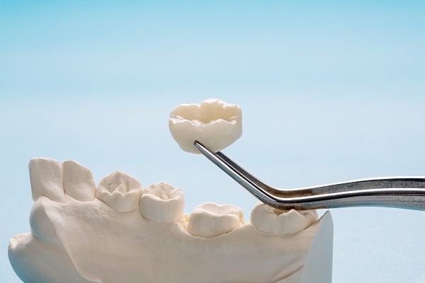 When a Dental Crown Is Needed for a Cavity