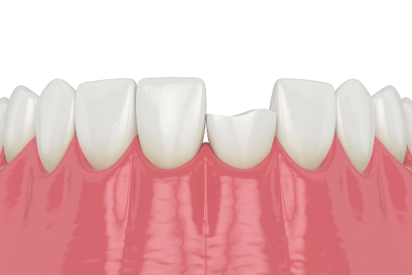 FAQs About Cosmetic Dentistry for Chipped Teeth