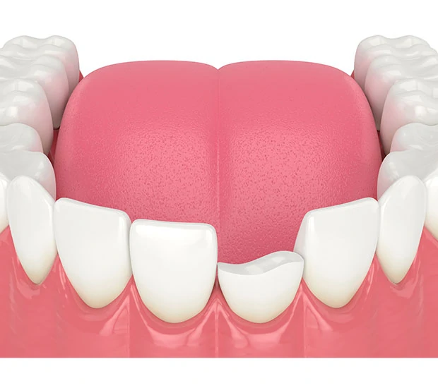 What Should I Do If I Chip My Tooth
