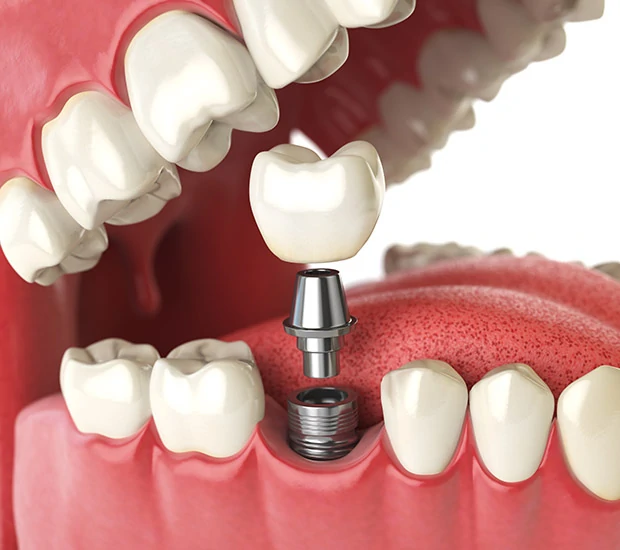 Will I Need a Bone Graft for Dental Implants