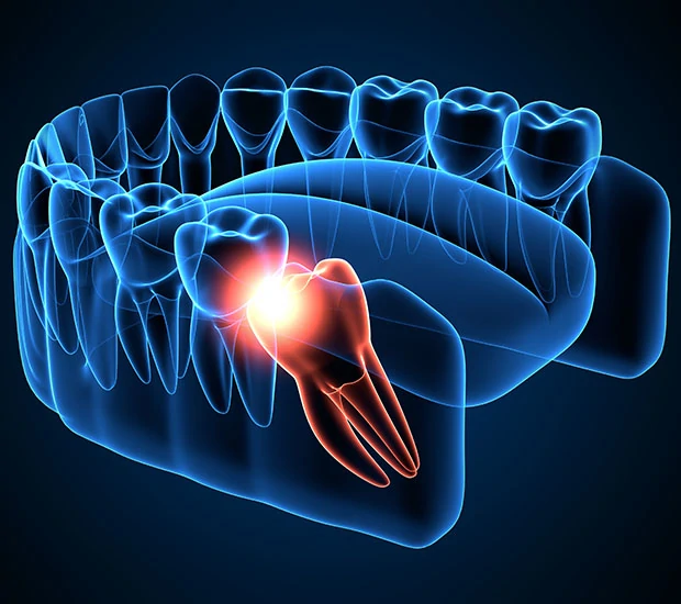 When Teeth Extraction: What to Expect