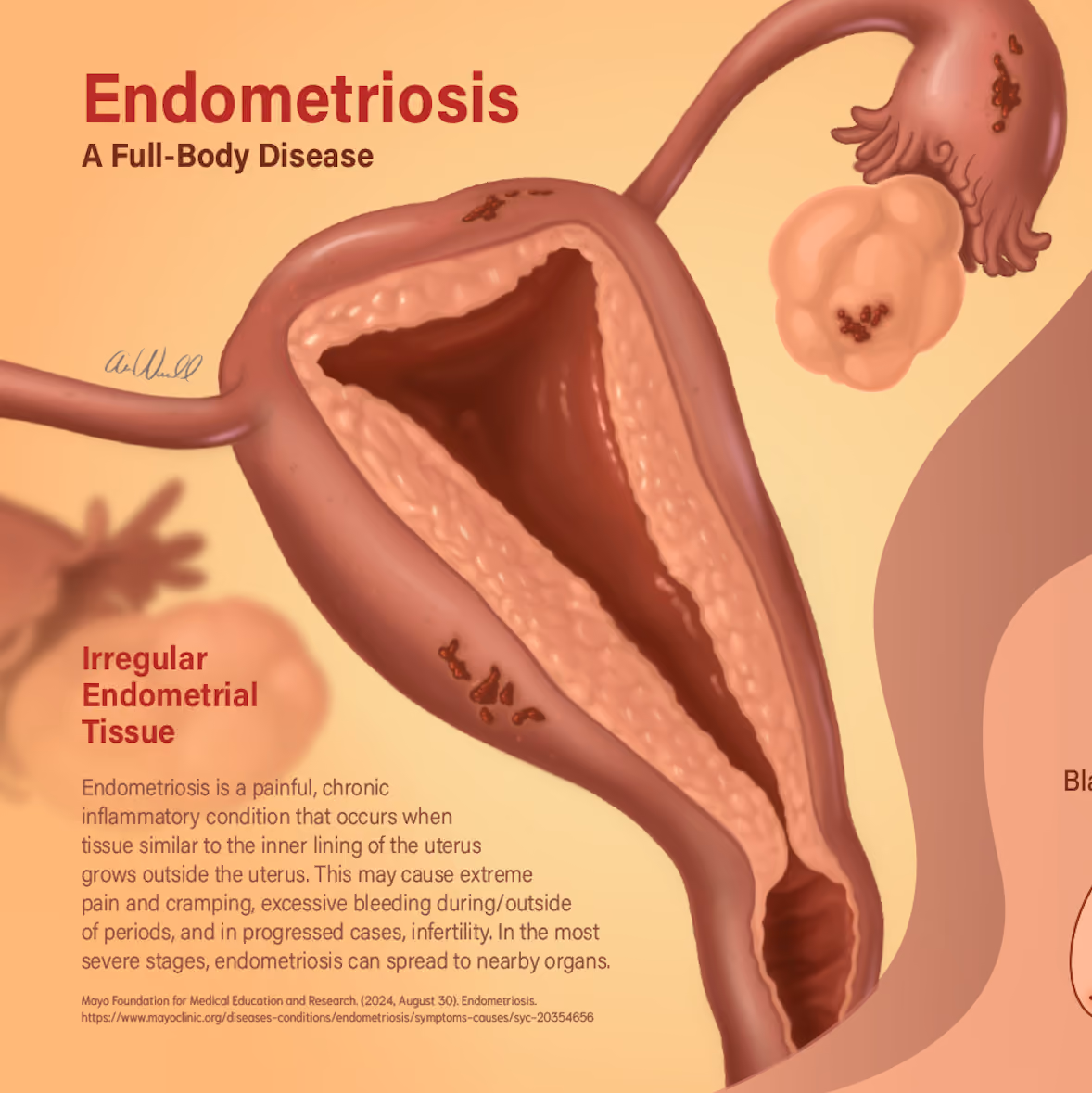 Illustration of uterus with irregular endometrial tissue showing endometriosis lesions on its surface.