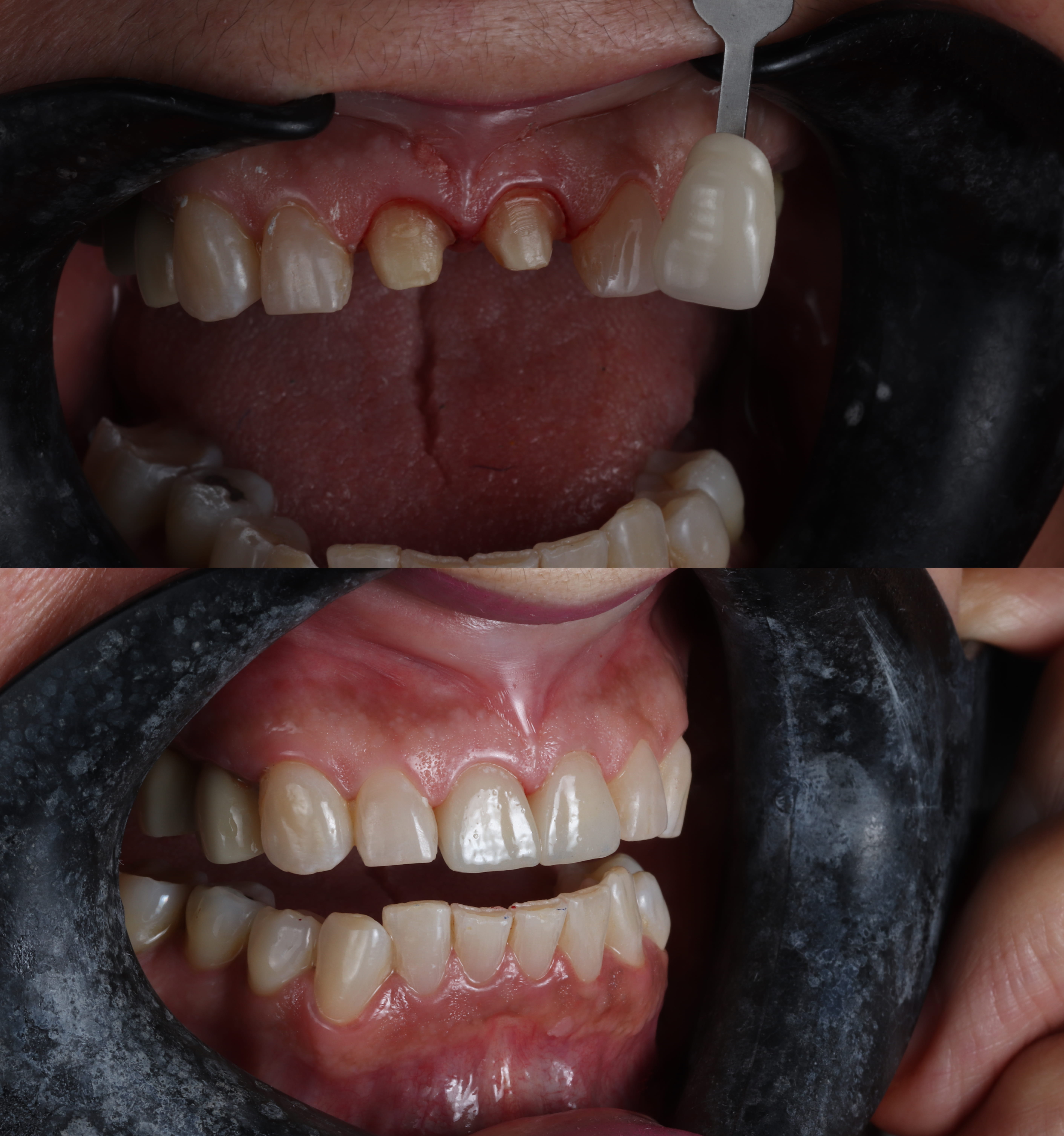 Two close-up views of a mouth showing dental preparation and restored front teeth.