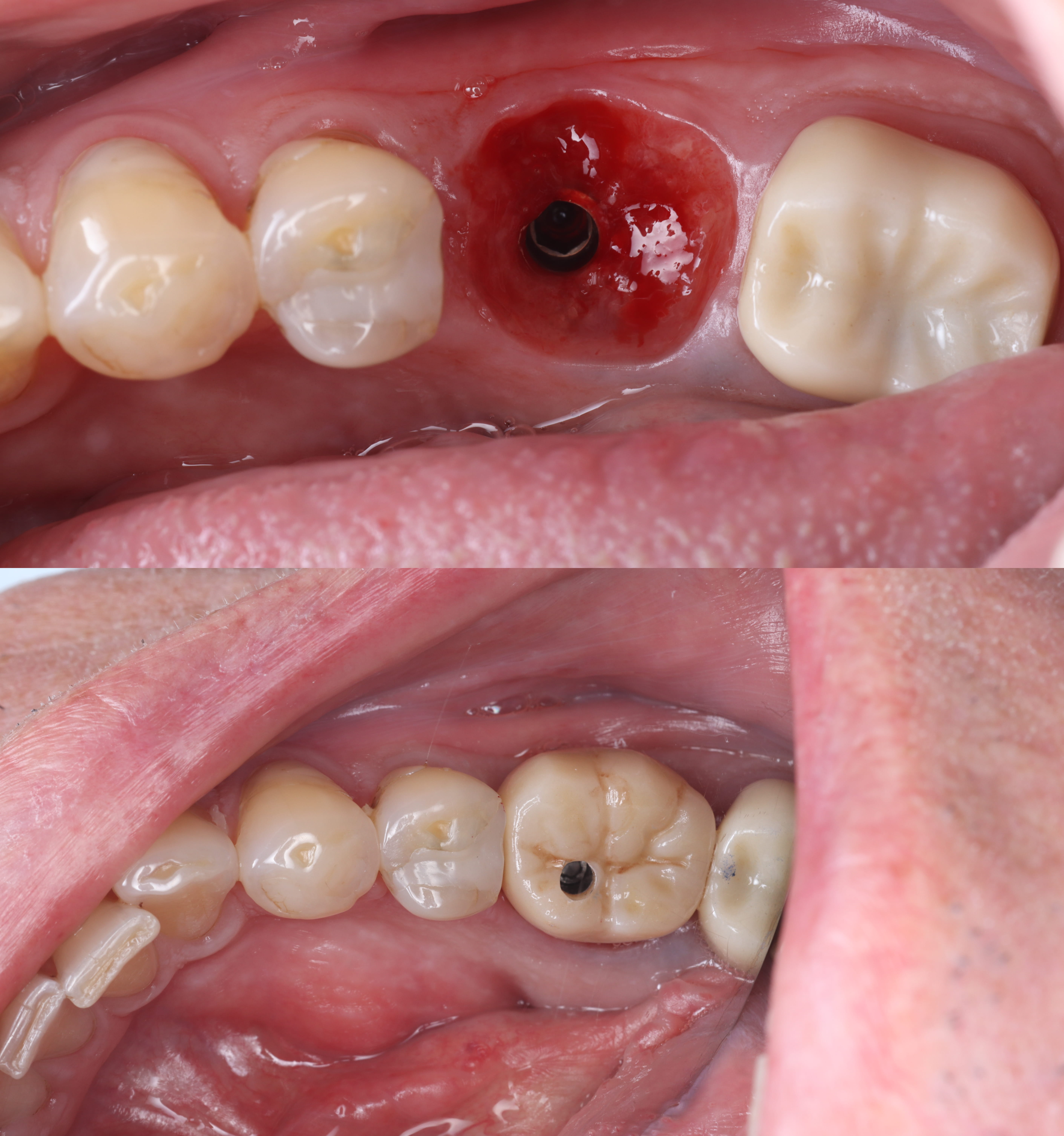 Close-up of dental implant site with healing abutment and restored tooth with screw access hole.