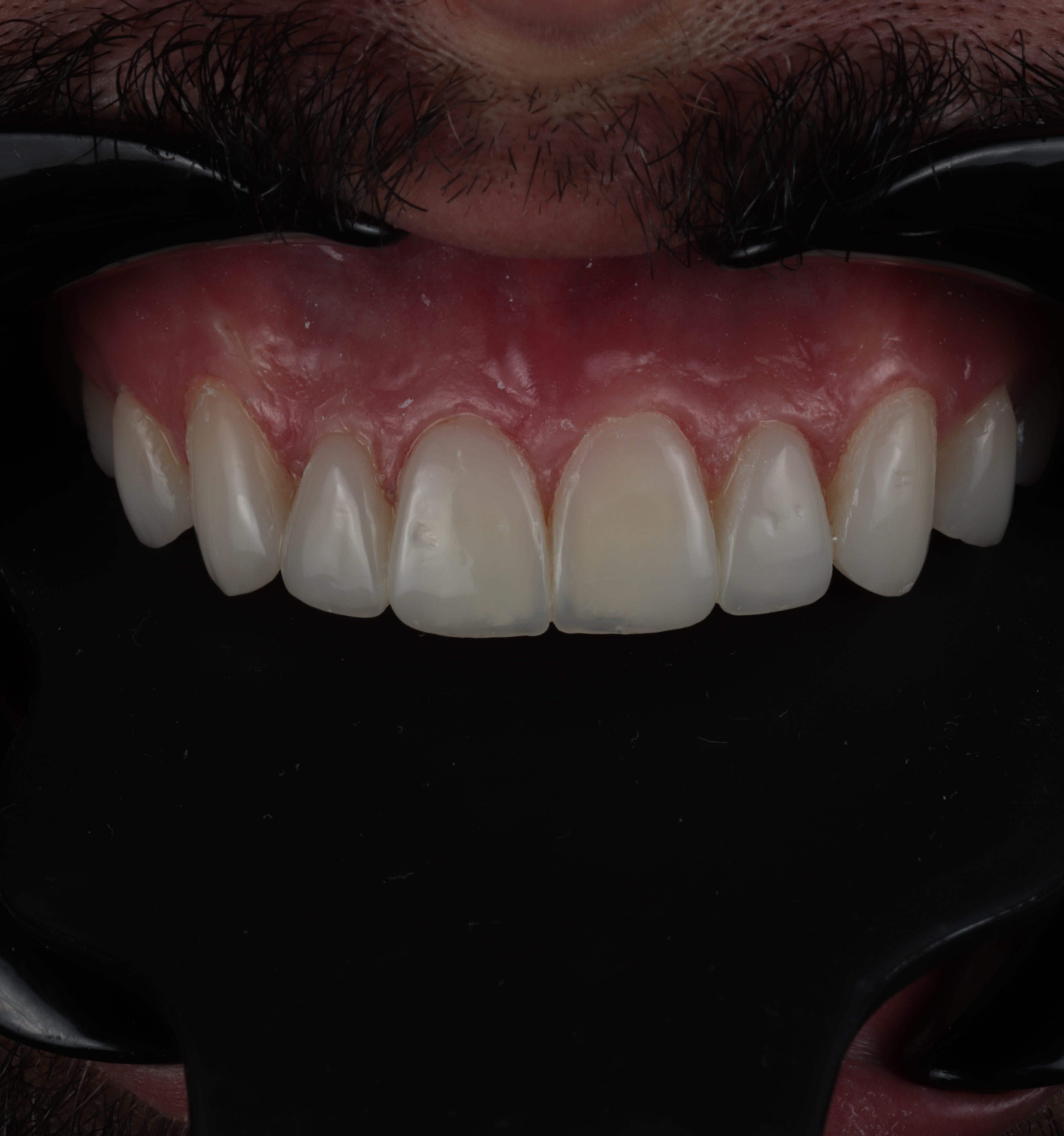 Close-up of upper front teeth and gums with a dental cheek retractor in place.