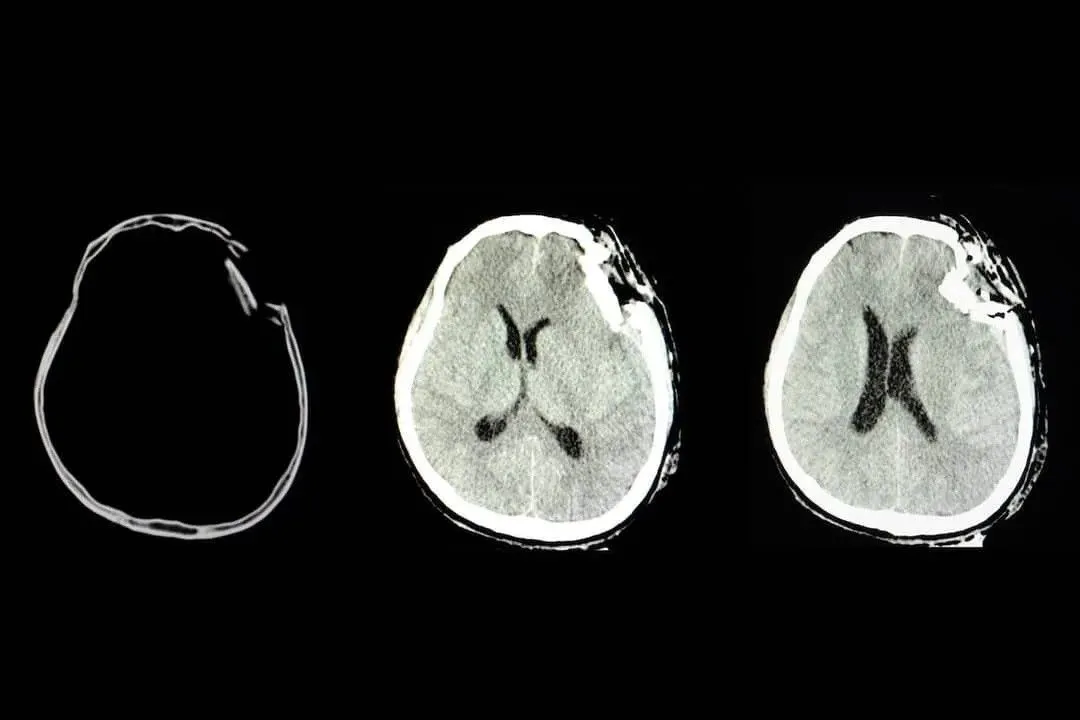 3 Million Dollar Settlement Reached in Traumatic Brain Injury Suit against Lowes