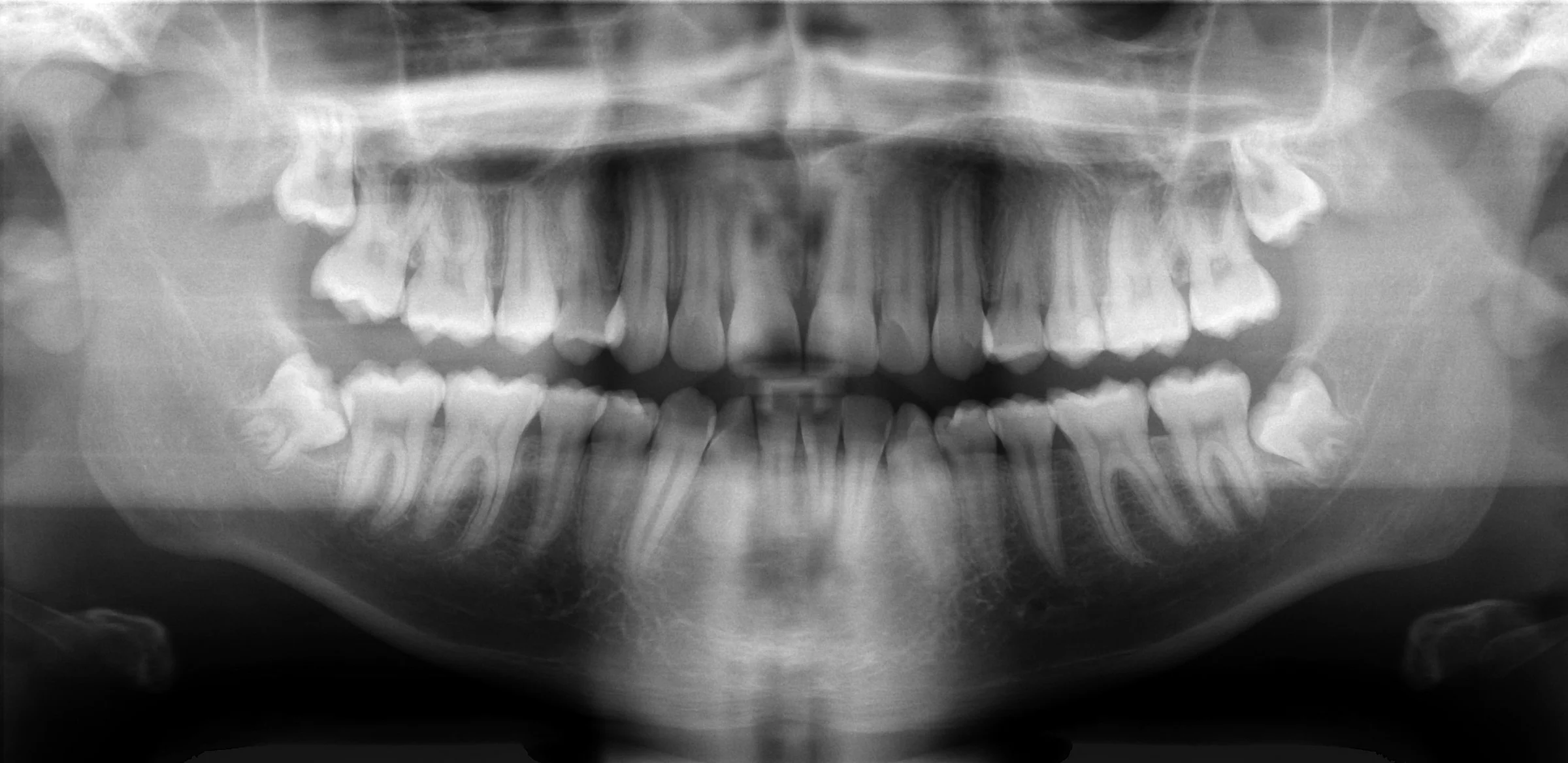 An example panoramic dental X-ray showing the upper and lower teeth