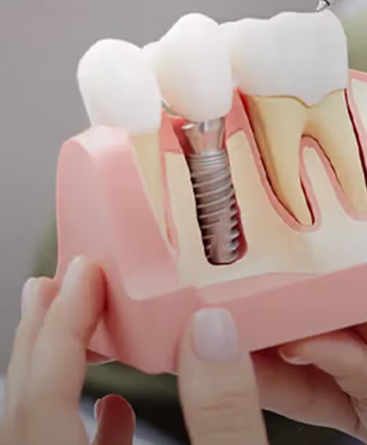 Model of dental implant showing titanium screw inserted into the jawbone with artificial tooth attached.