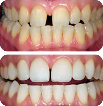 Comparison of teeth before and after whitening, showing yellowed teeth with gaps above and evenly white teeth below.