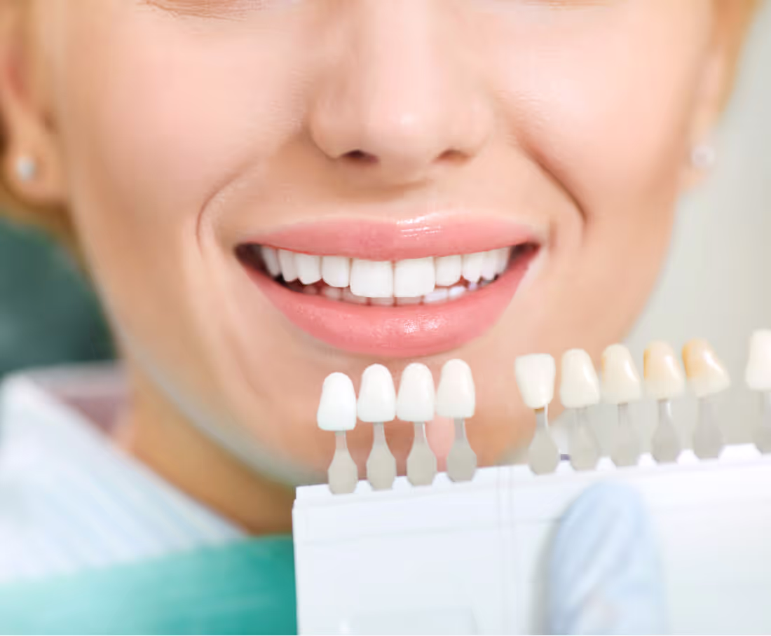 Close-up of a woman smiling with white teeth, matching her teeth shade to a dental color chart.