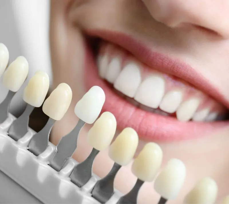 Close-up of a smiling person showing white teeth with a dental shade guide for tooth color matching.