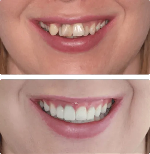 Close-up before and after images of a person's smile showing dental improvement with whiter and straighter teeth in the after photo.