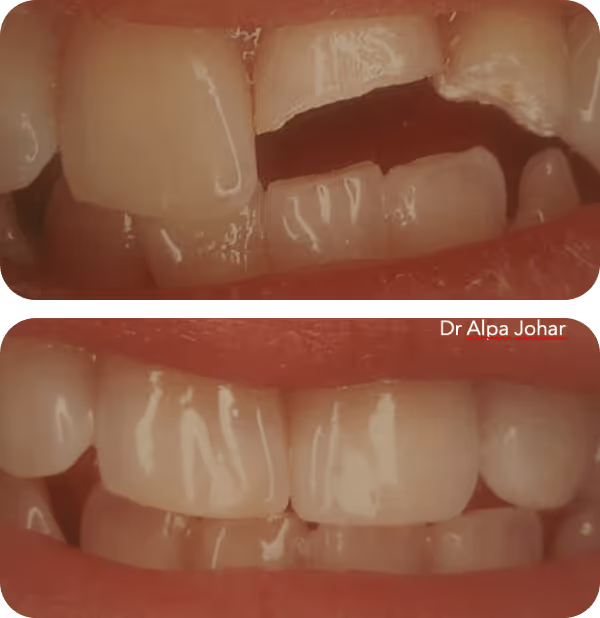Close-up comparison of teeth before and after dental restoration, showing broken and chipped upper front teeth in the top image and fully restored teeth in the bottom image.