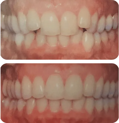 Comparison of teeth before and after dental treatment showing straighter, aligned teeth in the after image.
