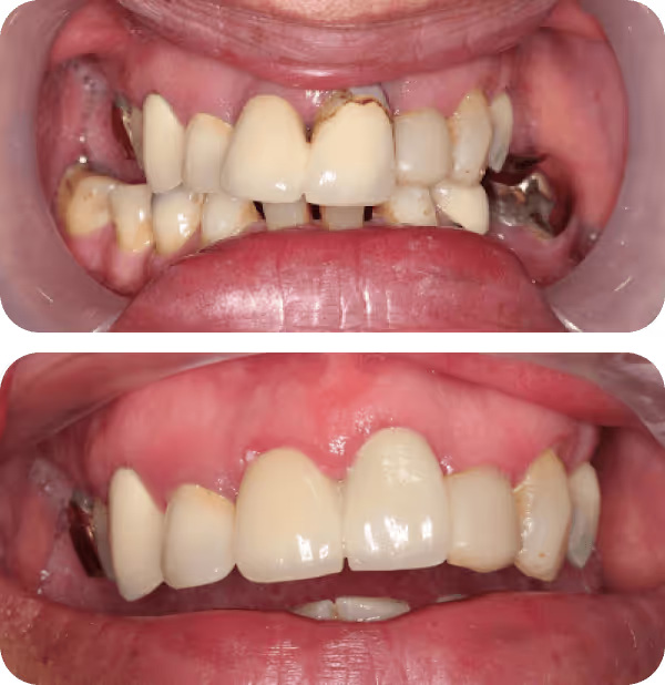 Before and after images showing dental restoration with improved alignment and cleanliness of upper front teeth.