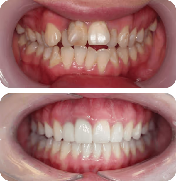 Before and after images of teeth showing dental restoration with crowns; the top image shows discolored and damaged teeth, the bottom image shows white, aligned teeth with crowns.