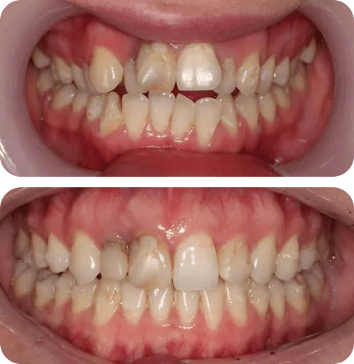 Close-up comparison of upper and lower teeth before and after whitening treatment showing improved tooth color and reduced yellow stains.
