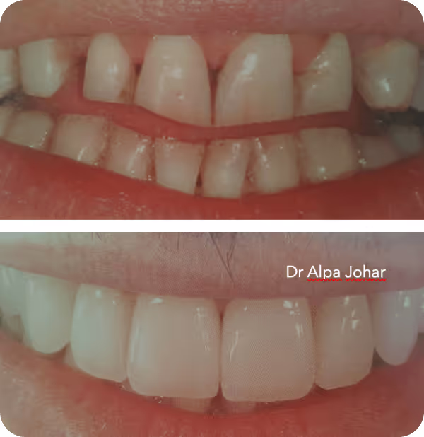 Comparison of teeth before and after dental veneers treatment showing uneven and chipped teeth above and smooth, evenly shaped teeth below.