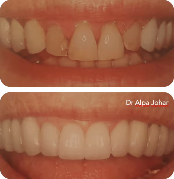 Close-up before-and-after photos showing dental transformation with crowns or veneers, improving teeth alignment and whiteness.