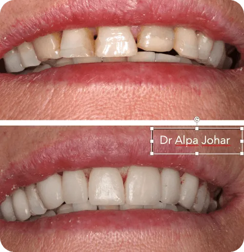 Close-up showing before and after dental restoration with improved teeth alignment and color.