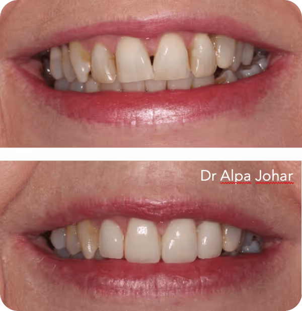 Comparison of a smile before and after dental treatment; the upper image shows crooked and discolored teeth, the lower image shows aligned, whiter teeth with the text 'Dr Alpa Johar'.