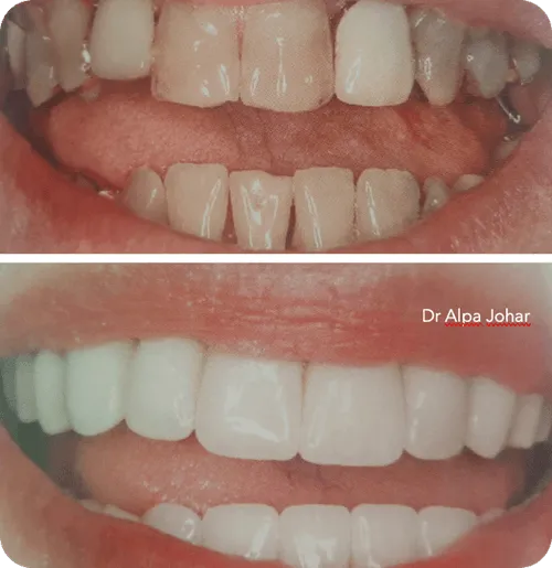 Before and after close-up images of a mouth showing dental veneer treatment with improved clean and aligned teeth in the after photo.