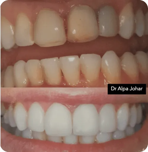 Comparison of teeth before and after dental veneers, showing discolored and uneven teeth transformed into a straight, white smile.