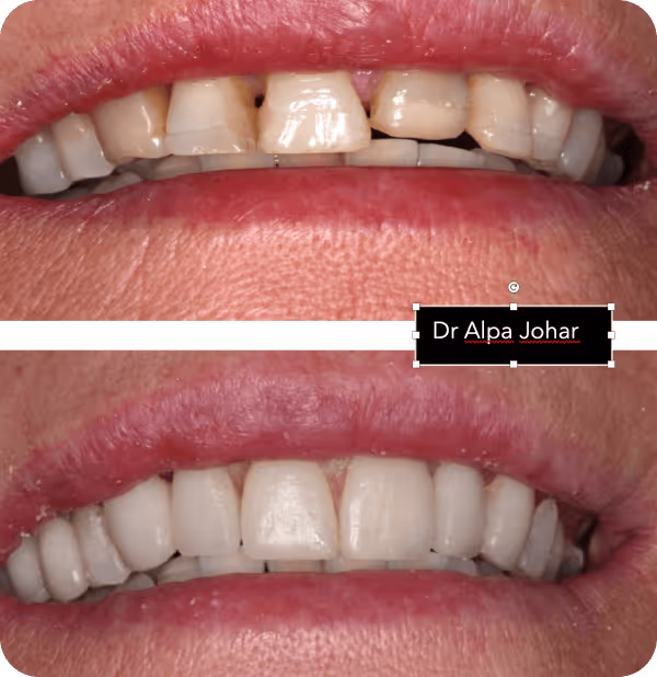 Before and after close-up view of a person's teeth showing discolored, uneven teeth above and white, evenly shaped teeth below after dental treatment.